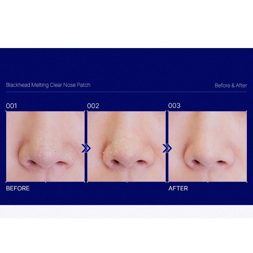 MEDIHEAL Blackhead Melting Clear Nose Patch 1ea