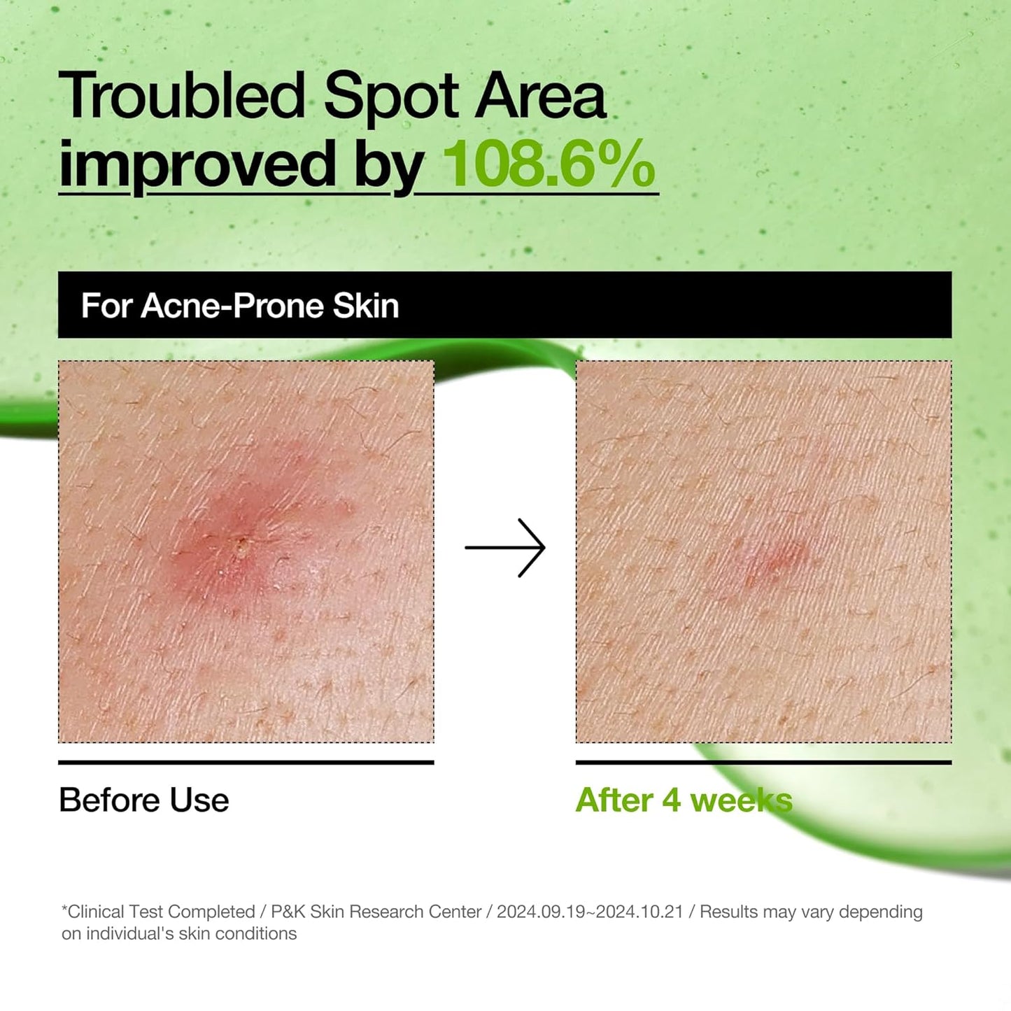 Azelaic Acid 10 Hyaluron Redness Soothing Serum, 30mL