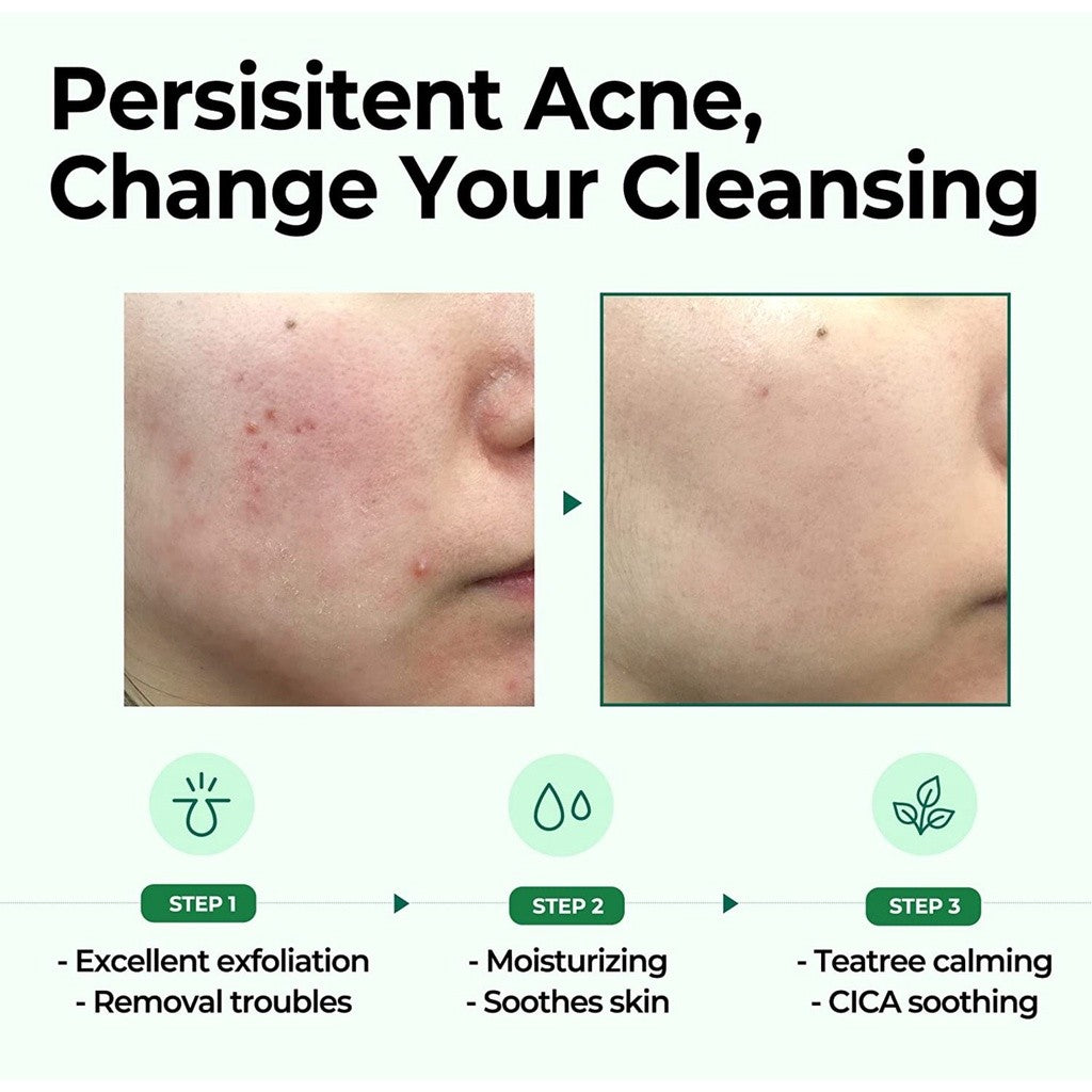 SOME BY MI AHA BHA PHA 30 Days Miracle Cleansing Bar - 3.73Oz, 106g - Mild Exfoliating Body Cleansing Soap - Moisturizing Effect, Pore and Sebum Care for Sensitive Skin - Body Skin