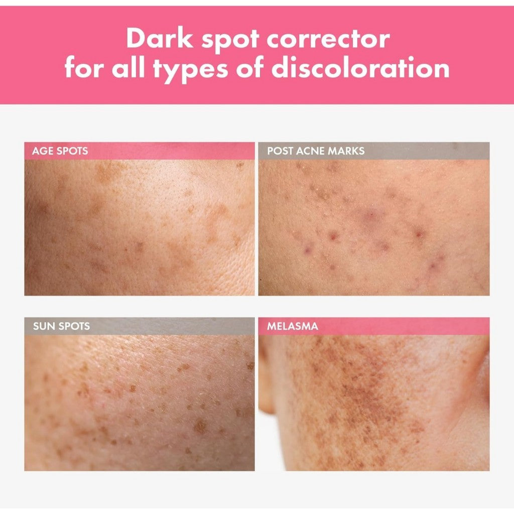 TOSOWOONG Arbutin 7% Intensive Spot Cream, 20mL with 70,000ppm Arbutin, 3% Tranexamic Acid, 1% Niacinamide