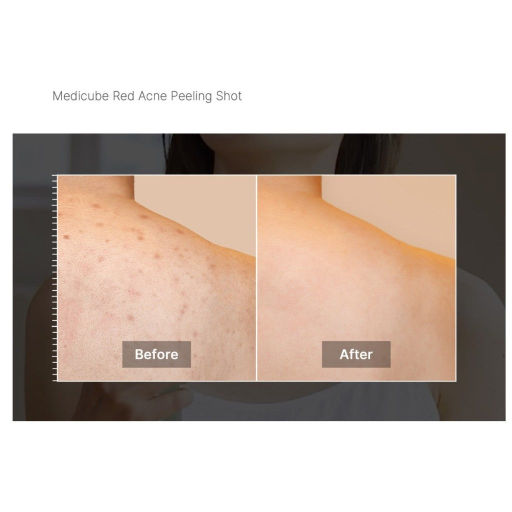 [NEW] MEDICUBE Red Acne Body Peeling Shot 2.0 110g