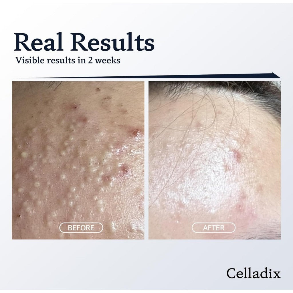 Gel limpiador Celladix Acne Control 131, 110 ml