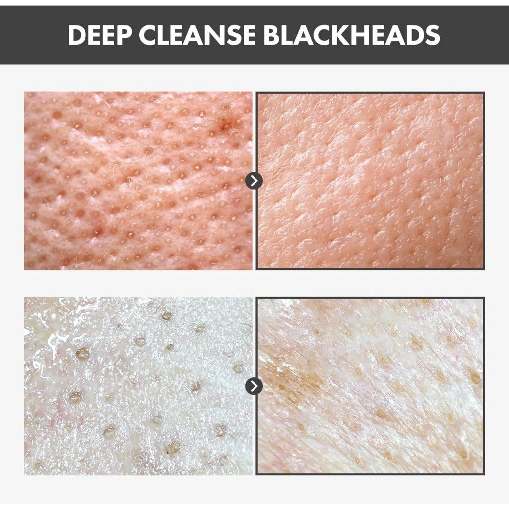 TOSOWOONG Blackhead Peel Off Pack, 50g